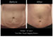 endermologie® Better Than CoolSculpting